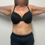 Arm Lift Before & After Patient #2347