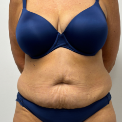Tummy Tuck Before & After Patient #2351