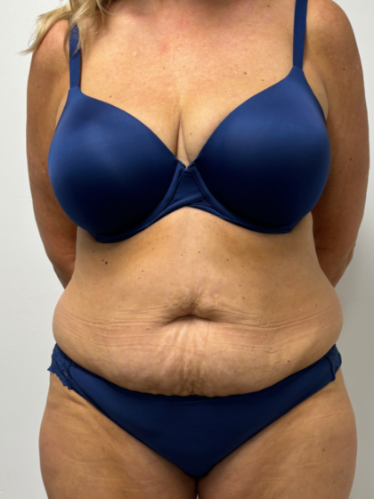 Tummy Tuck Before & After Patient #2351