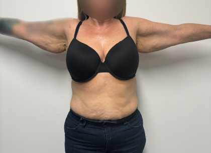 Arm Lift Before & After Patient #2347
