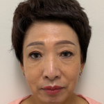 Fillers Before & After Patient #2349