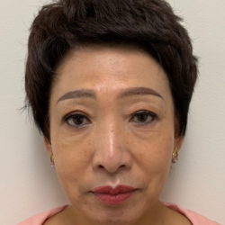 Fillers Before & After Patient #2349