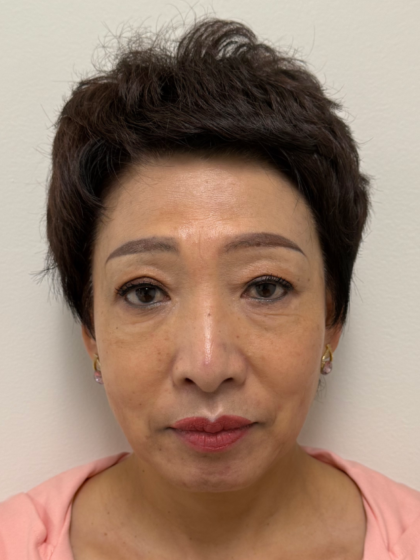 Fillers Before & After Patient #2349