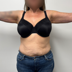 Arm Lift Before & After Patient #2347