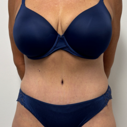Tummy Tuck Before & After Patient #2351