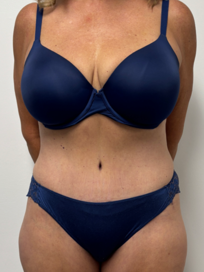 Tummy Tuck Before & After Patient #2351