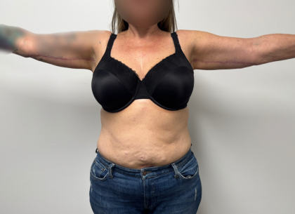 Arm Lift Before & After Patient #2347