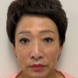 Fillers Before & After Patient #2349