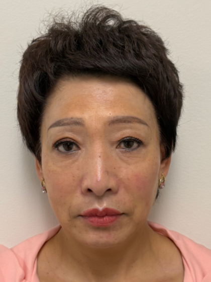 Fillers Before & After Patient #2349