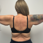 Arm Lift Before & After Patient #2347