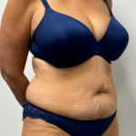Tummy Tuck Before & After Patient #2351