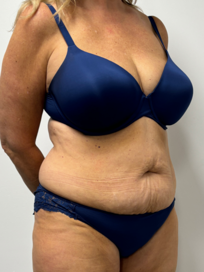 Tummy Tuck Before & After Patient #2351