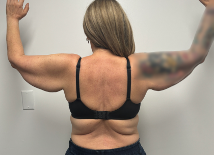Arm Lift Before & After Patient #2347