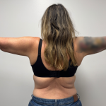 Arm Lift Before & After Patient #2347