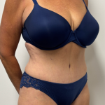 Tummy Tuck Before & After Patient #2351