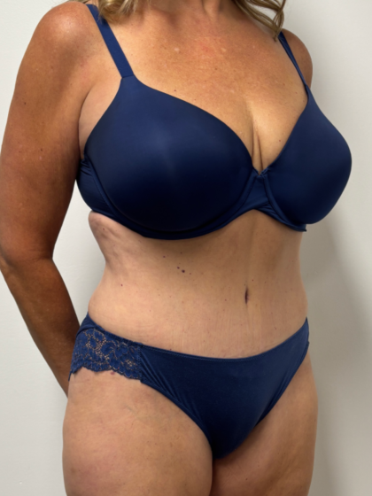 Tummy Tuck Before & After Patient #2351