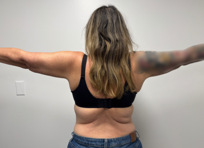 Arm Lift Before & After Patient #2347
