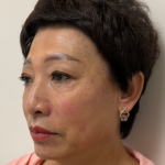 Fillers Before & After Patient #2349
