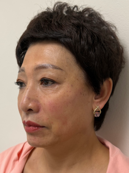 Fillers Before & After Patient #2349