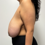 Breast Reduction Before & After Patient #2348