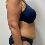 Tummy Tuck Before & After Patient #2351
