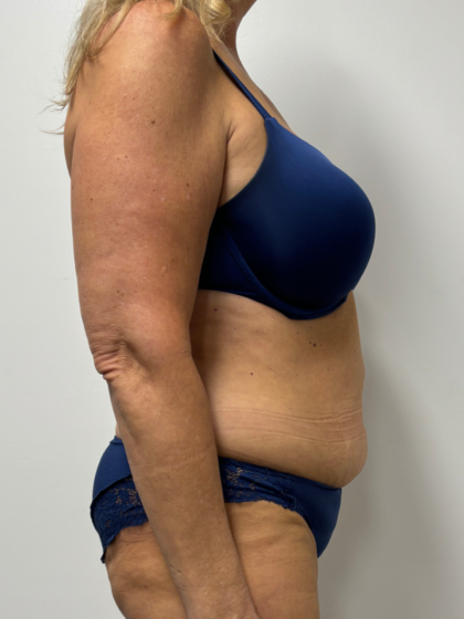 Tummy Tuck Before & After Patient #2351