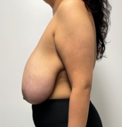 Breast Reduction Before & After Patient #2348