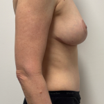 Mommy Makeover Before & After Patient #2350