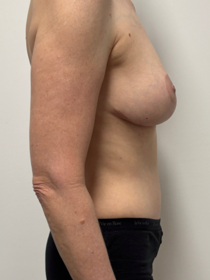 Mommy Makeover Before & After Patient #2350