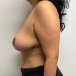 Breast Reduction Before & After Patient #2348