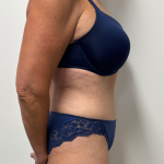 Tummy Tuck Before & After Patient #2351