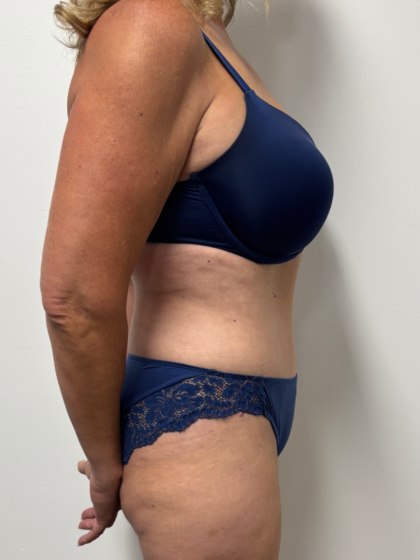 Tummy Tuck Before & After Patient #2351