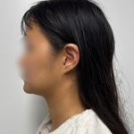 Neck liposuction Before & After Patient #2412