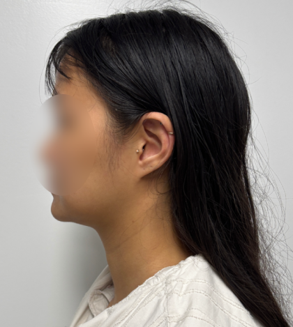 Neck liposuction Before & After Patient #2412