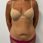 Abdominoplasty Before & After Patient #2408