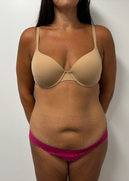 Abdominoplasty Before & After Patient #2408
