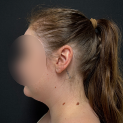 Neck liposuction Before & After Patient #2411