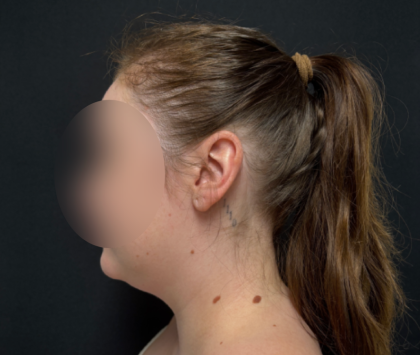 Neck liposuction Before & After Patient #2411