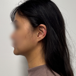 Neck liposuction Before & After Patient #2412