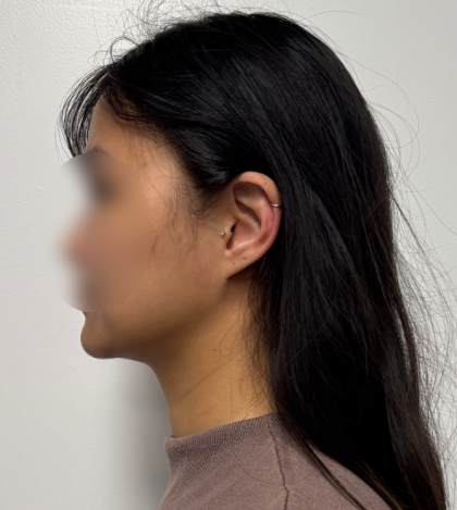Neck liposuction Before & After Patient #2412