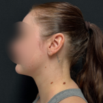 Neck liposuction Before & After Patient #2411