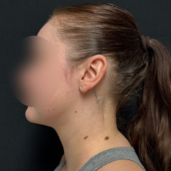Neck liposuction Before & After Patient #2411