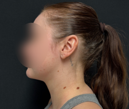 Neck liposuction Before & After Patient #2411
