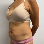Abdominoplasty Before & After Patient #2409