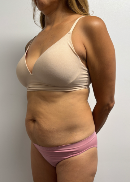 Abdominoplasty Before & After Patient #2409