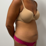 Abdominoplasty Before & After Patient #2408