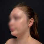 Neck liposuction Before & After Patient #2411