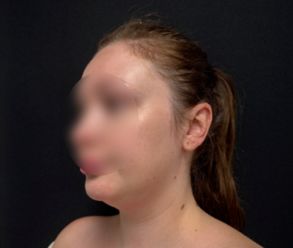 Neck liposuction Before & After Patient #2411