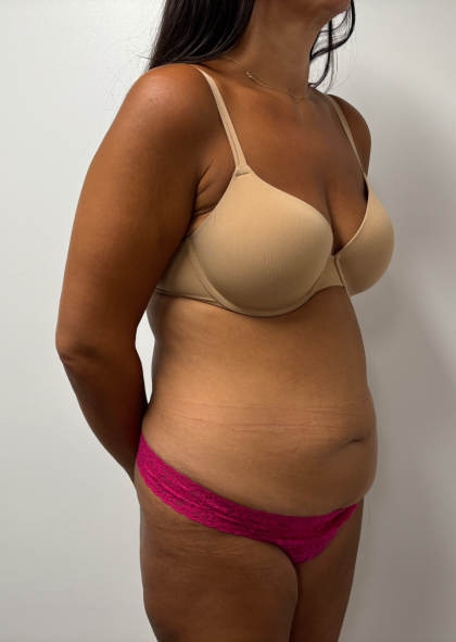 Abdominoplasty Before & After Patient #2408