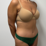 Abdominoplasty Before & After Patient #2408